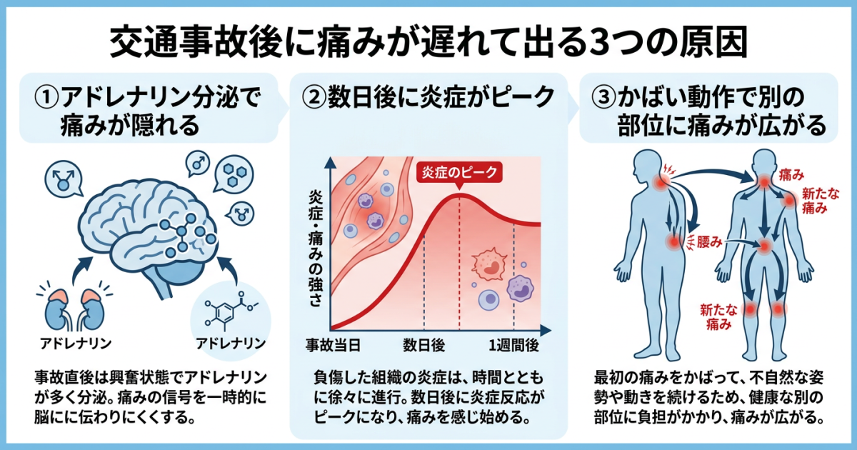 ■交通事故の数日後に痛みが遅れて出る3つの原因